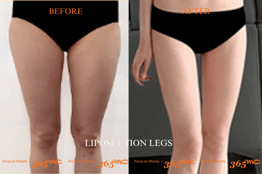 Liposuction - Legs