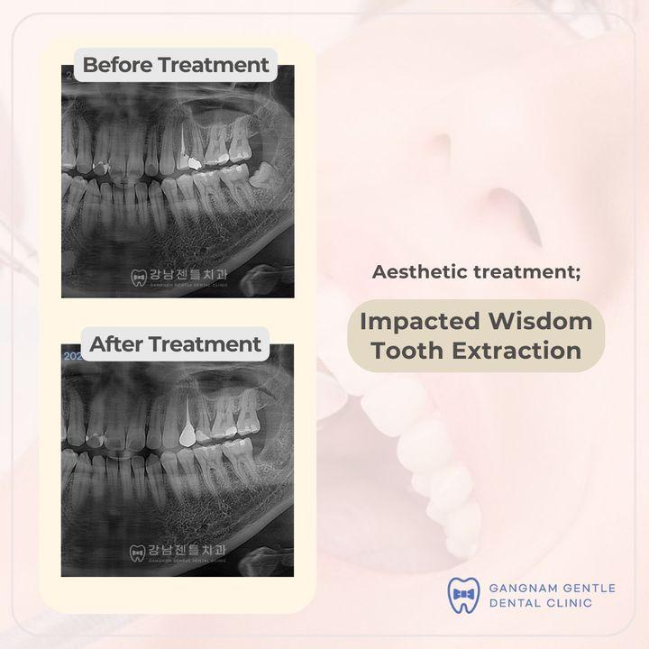 Wisdom tooth extraction: Don't let impacted wisdom teeth ruin your smile. Our experienced dentists can help you get the best possible results. Schedule your appointment today! ^^ Wisdom tooth extraction is a common dental procedure performed when the third molars, known as wisdom teeth, cause issues such as impaction, crowding, pain, infection, or other dental problems.