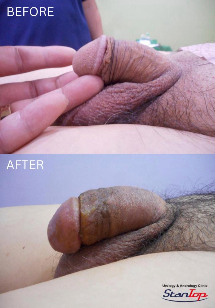 Penis Enlargement