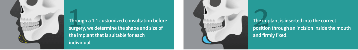 Chin Implant