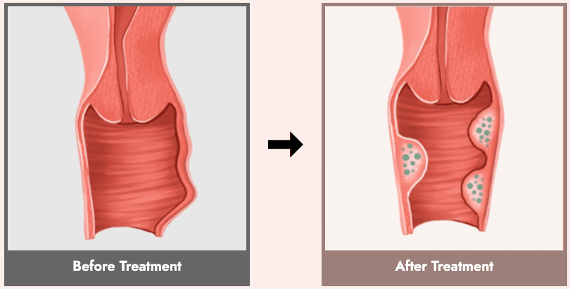 Vaginal Filler