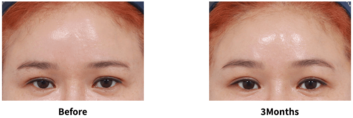 Forehead Lift