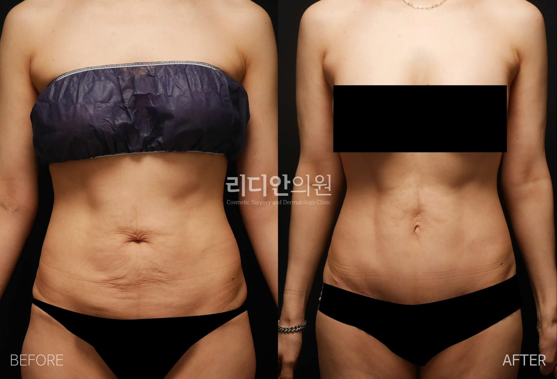 pregnancy tummy tuck before after