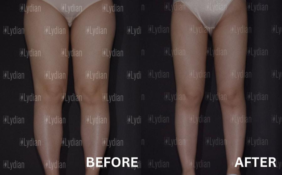 Lydian Plastic Surgery Clinic before and after image