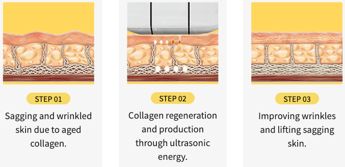 Ultherapy Lifting