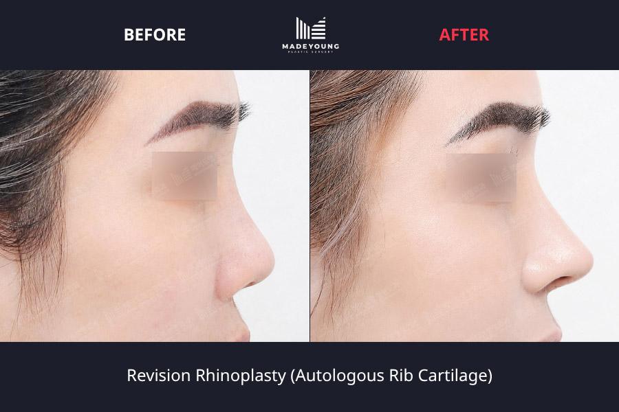 Rhinoplasty autologous rib cartilage