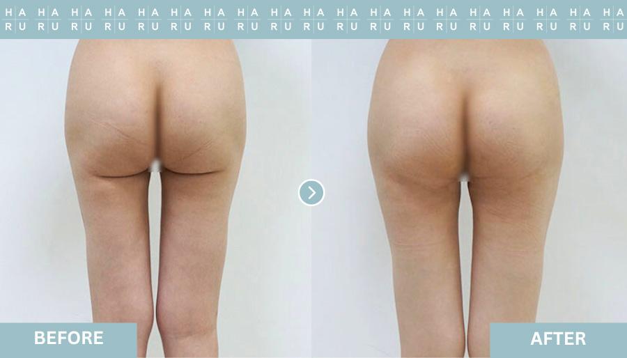 Butt Thread Lift & Filler