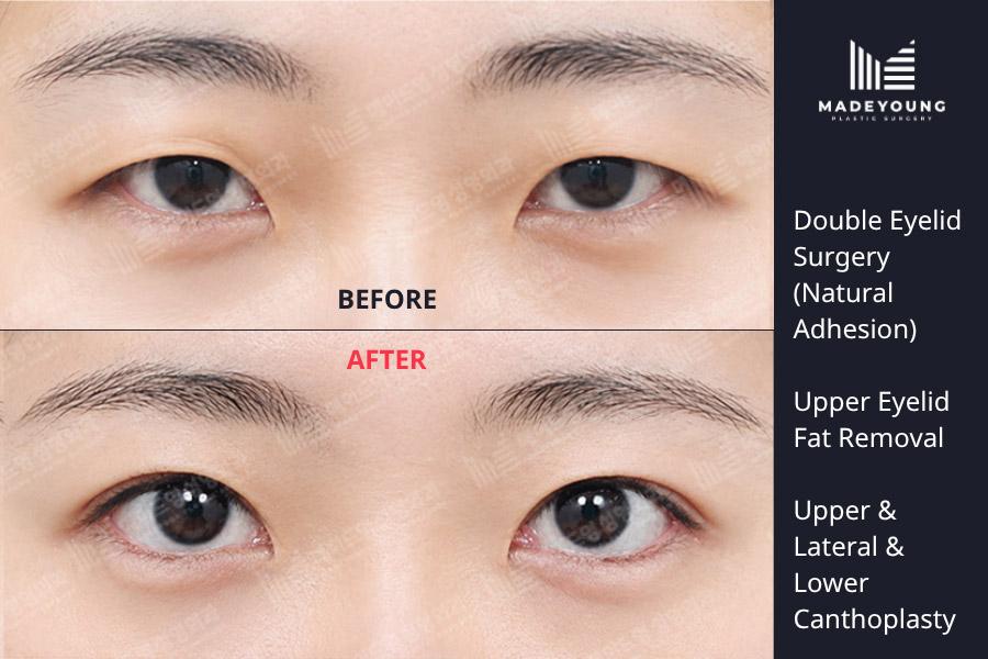 Eyelid surgery natural adhesion upper eyelid fat removal upper canthoplasty lateral canthoplasty lower canthoplasty