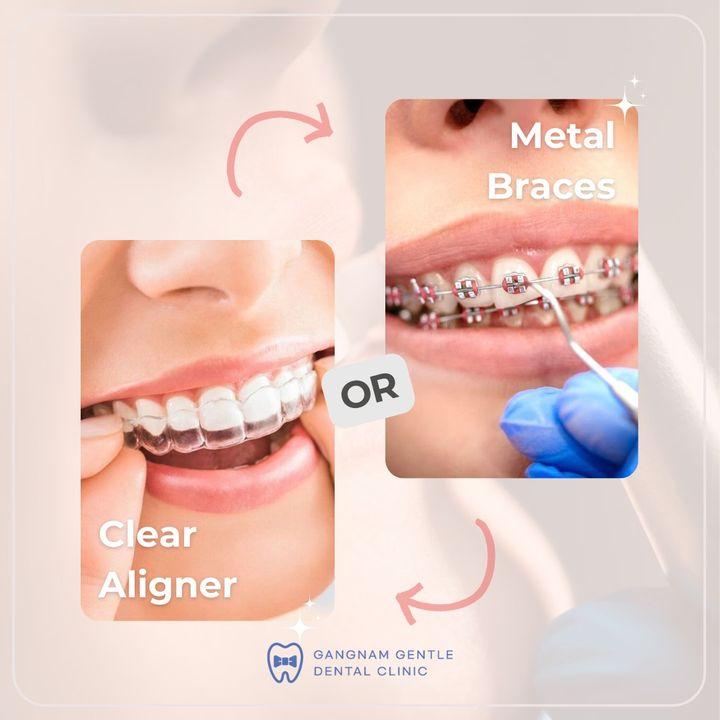 Clear Aligners, Braces, Clippy-C Braces