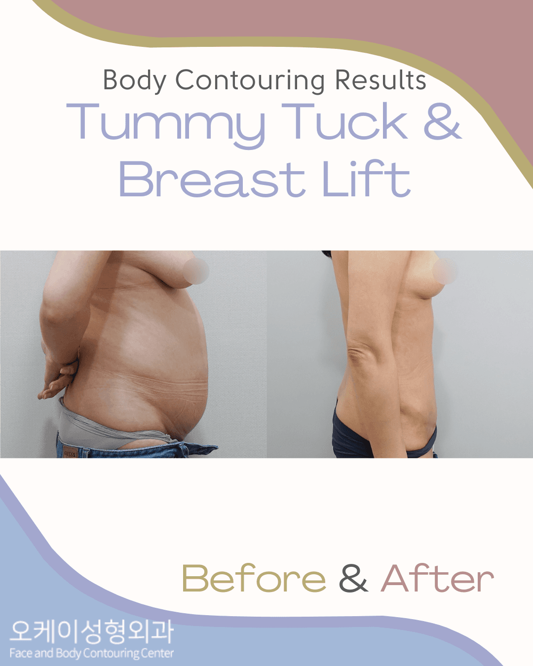 Okay Plastic Surgery Clinic before and after image