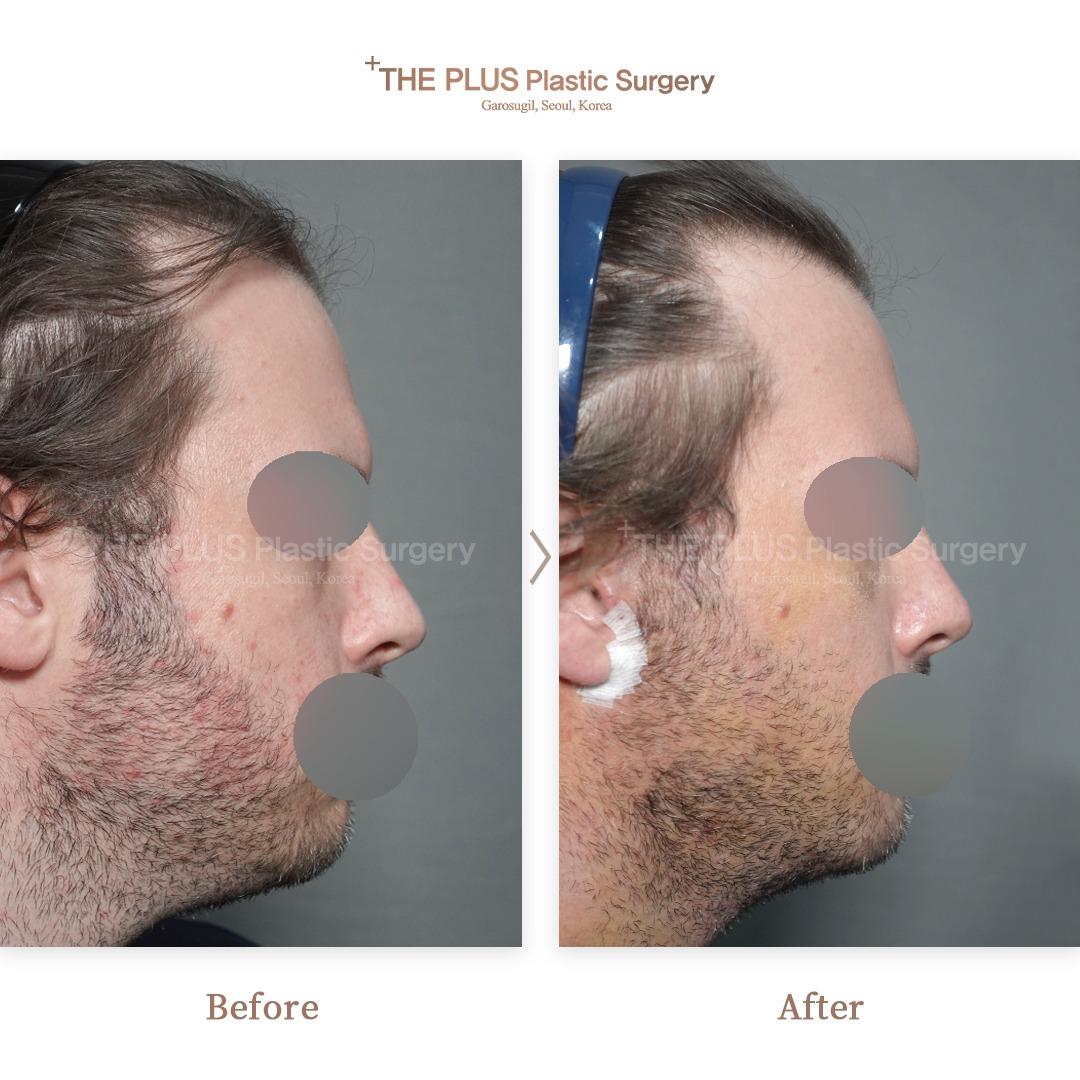 Mini Face Lifting + Double Chin Tightening + Chin Surgery