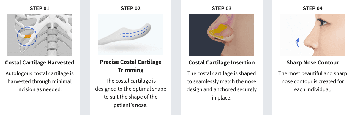 Rhinoplasty