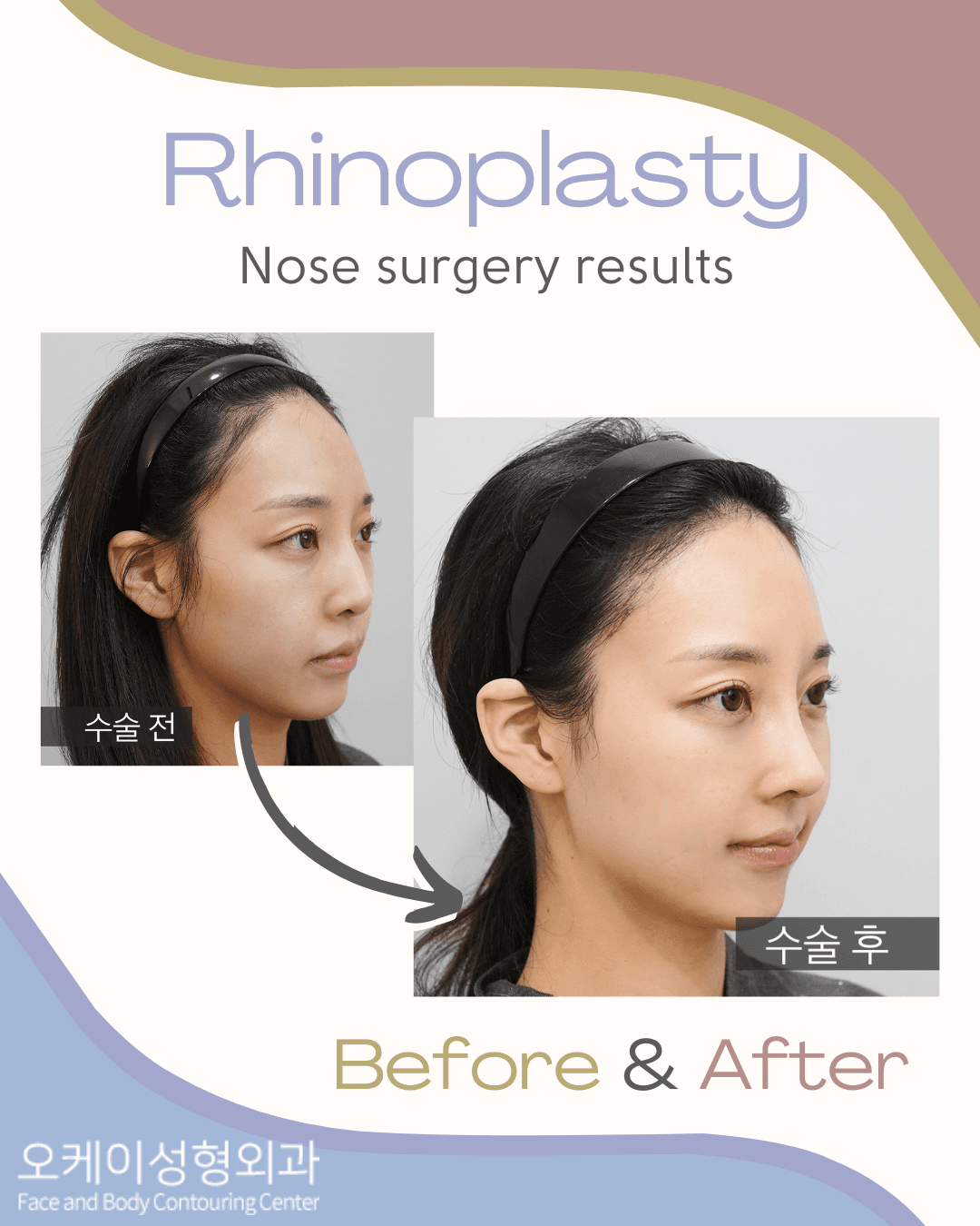 Vorher-Nachher-Bild der Okay Plastic Surgery Clinic