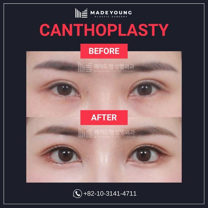 Canthoplasty can enhance the natural beauty of your eyes, providing a more open and youthful appearance. Our before and after photos demonstrate the precise and subtle results achieved through this specialized procedure. At MadeYoung, we are dedicated to helping you look and feel your best.