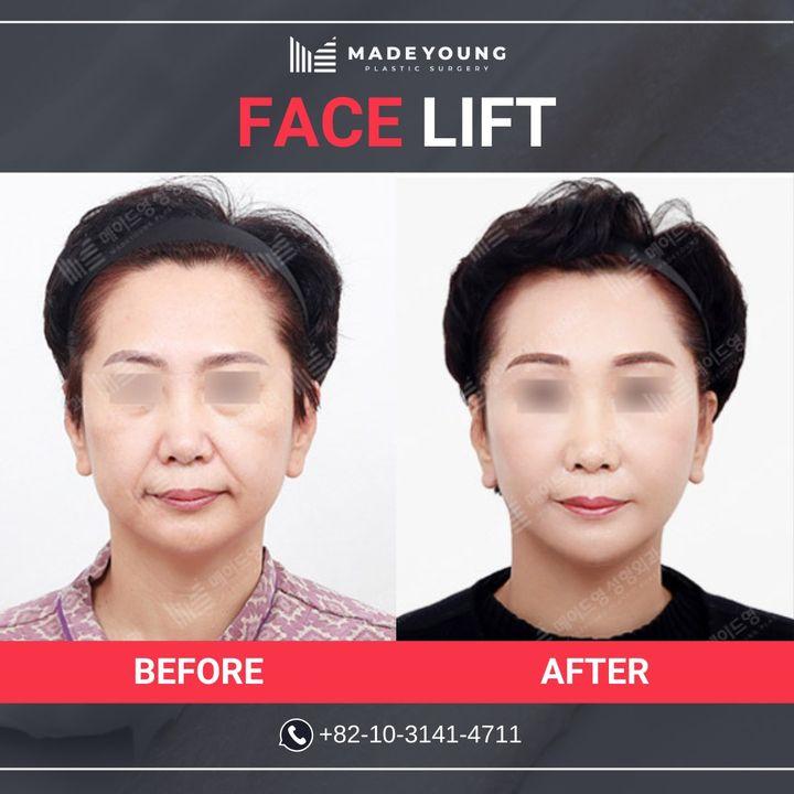 Rejuvenate your appearance with a facelift that delivers natural and lasting results. Our before and after images showcase the transformative effects of this procedure, reducing signs of aging and restoring a youthful contour to the face. Trust MadeYoung to guide you through your aesthetic journey with expertise and care.