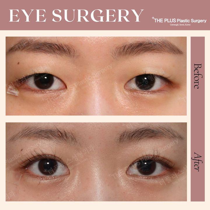 Eye Surgery at ThePlus! 🌟 Explore the transformative world of eye surgery, where precision meets elegance. Whether enhancing eyelids or brightening your gaze, discover the artistry of reawakening your eyes. Ready for a refreshed look? Let's embark on your journey to brighter, more confident eyes! ►