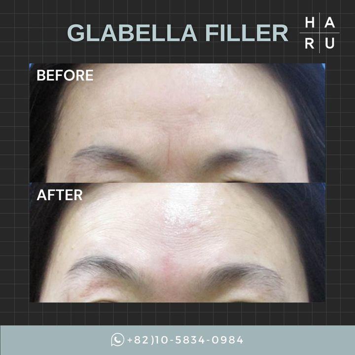 Transform the way you express yourself with our Glabella Filler treatment. Designed to smooth the lines between your brows, this quick procedure helps reflect your inner youth and vitality. See the difference with Haru Clinic - where subtle changes make a significant impact. đ