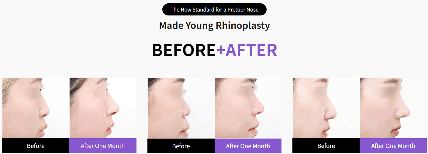 Rhinoplastik Vorher und Nachher