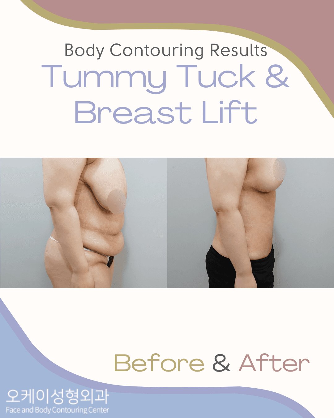 Okay Plastic Surgery Clinic before and after image