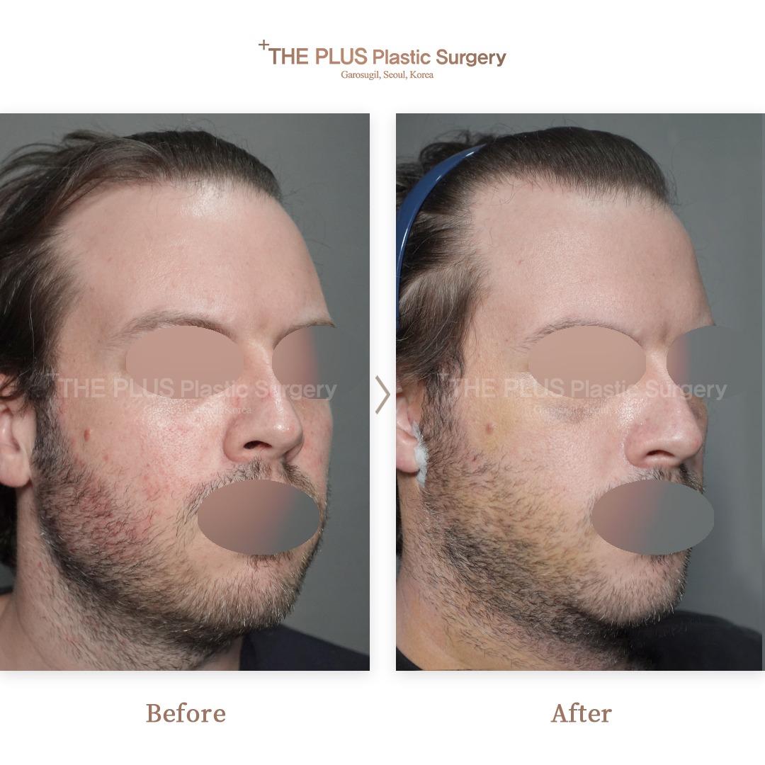 Mini Face Lifting + Double Chin Tightening + Chin Surgery