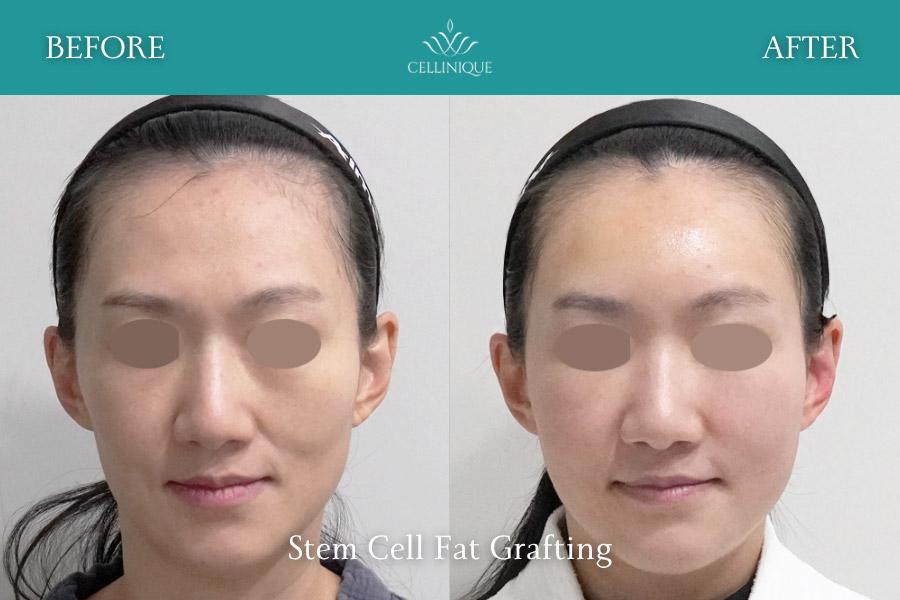 Cellinique Clinic before and after image