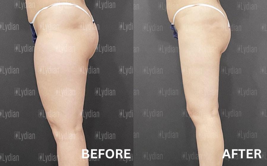 Lydian Plastic Surgery Clinic before and after image