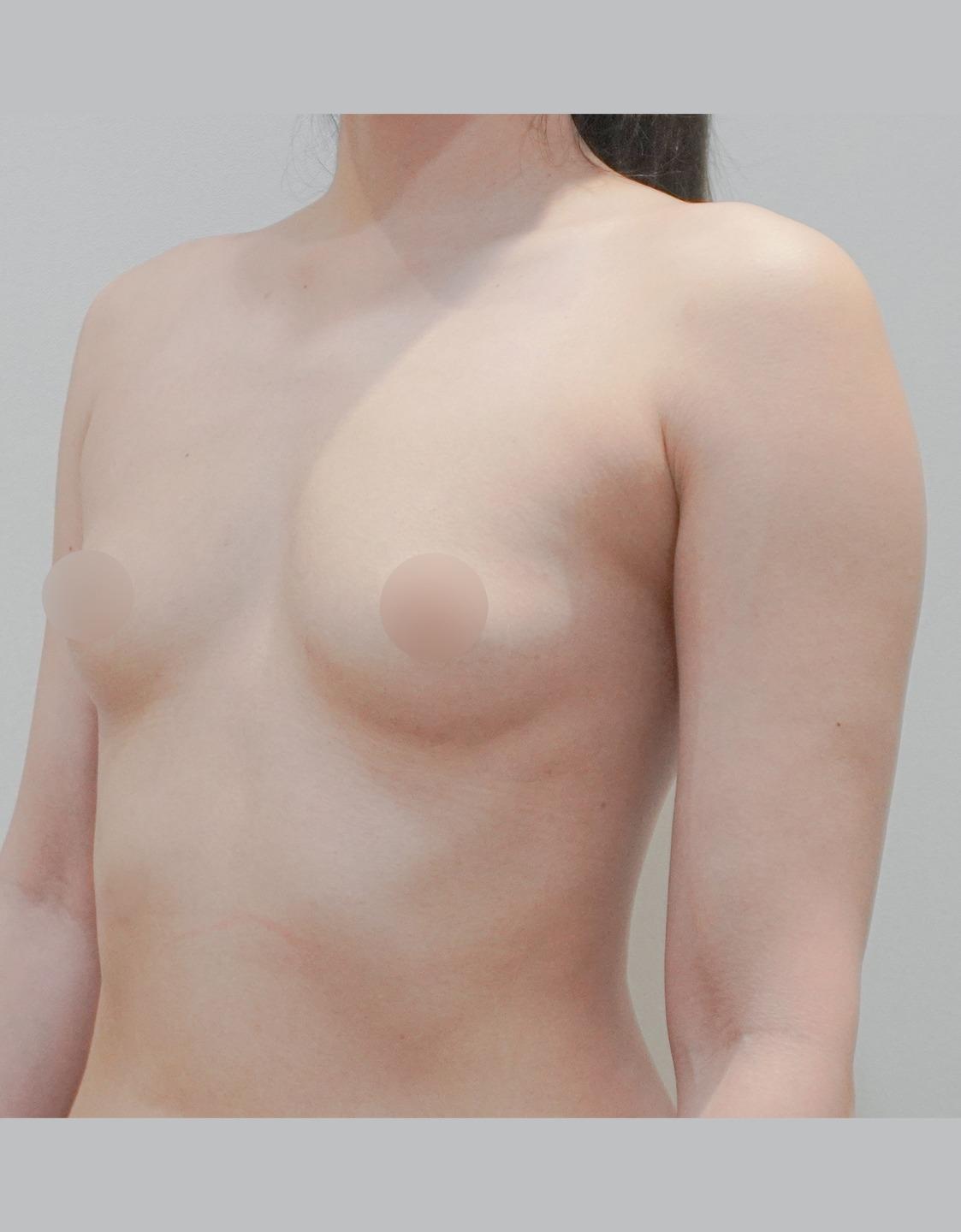 Breast Implant • Additional Procedures: • Arm Liposuction • Axillary Liposuction • Belody Lifting • After: 307 days post-op • Details: Motiva Demi 320cc, axillary fat removal, arm liposuction, Belody (back + side of arms)