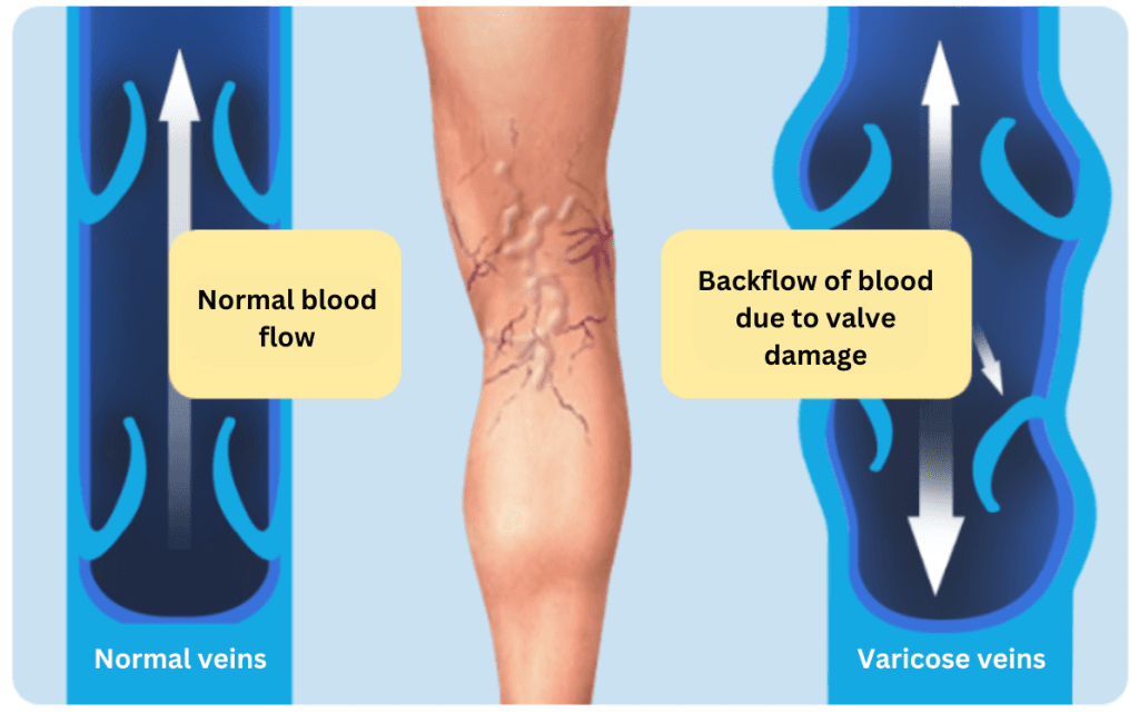 Varicose Vein Treatment
