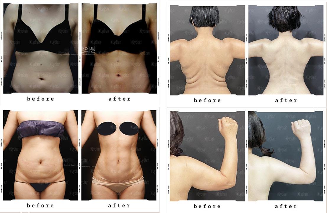 Liposuction before and after