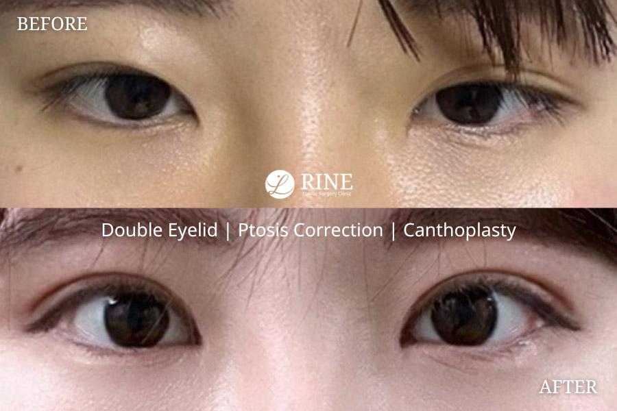 Double Eyelid ptosis correction canthoplasty