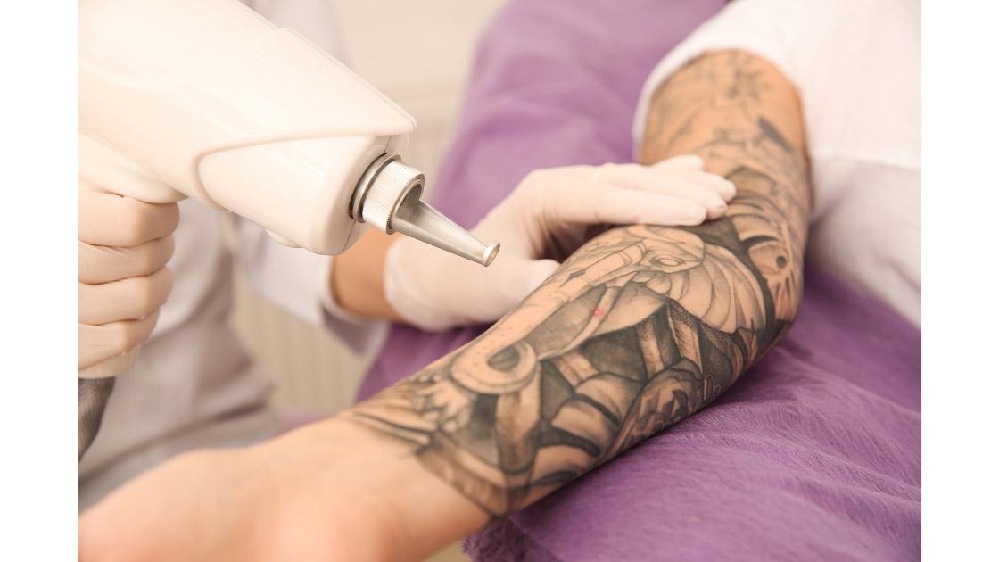 Laser Tattoo Removal