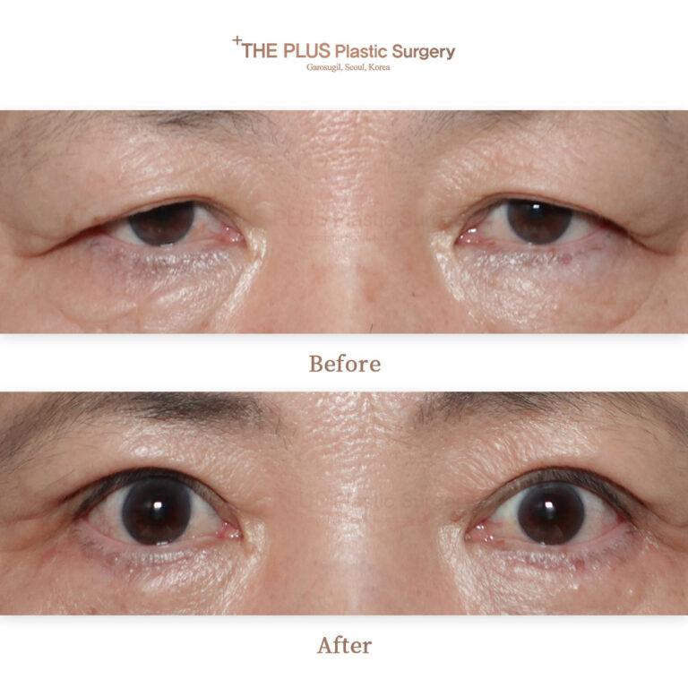 THEPLUS Plastic Surgery before and after image