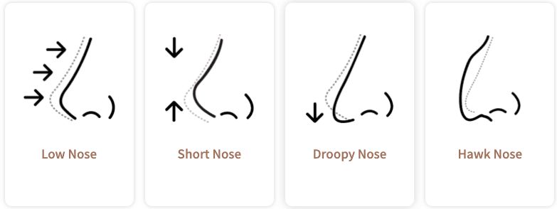 Rhinoplastik