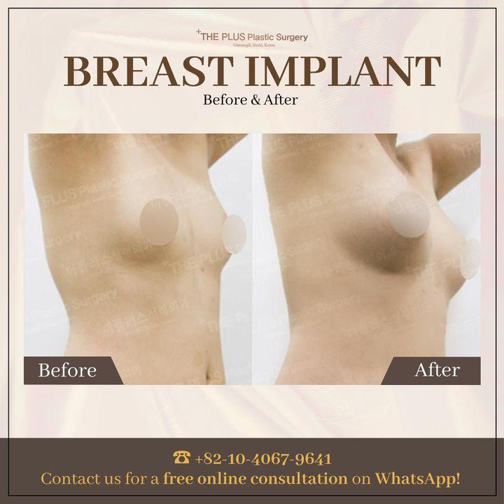 THEPLUS Plastic Surgery before and after image