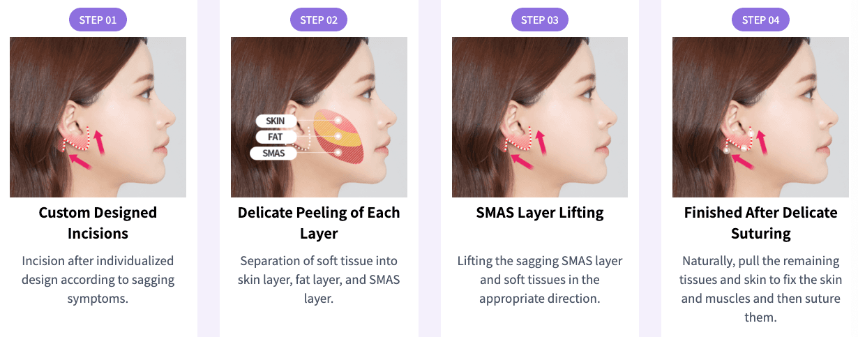 Face Lift