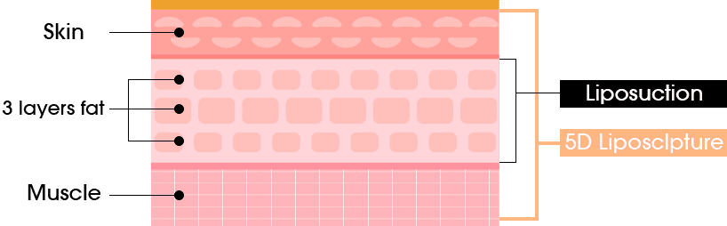 5D Liposculpture