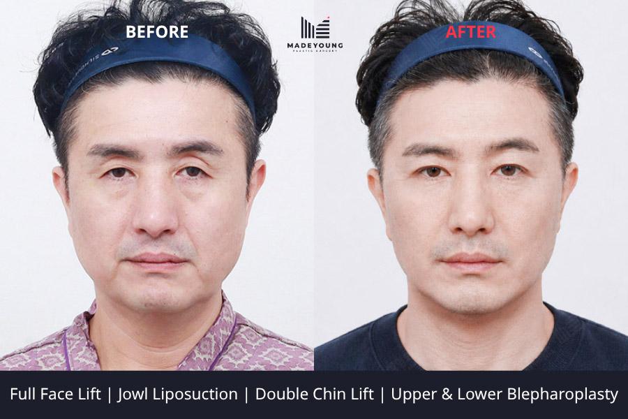 Face lift jowl liposuction double chin lift upper blepharoplasty upper eyelid fat grafting lower blepharoplasty