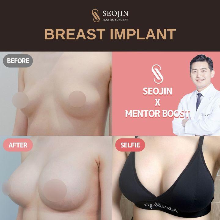 Seojin Plastic Surgery Clinic before and after image