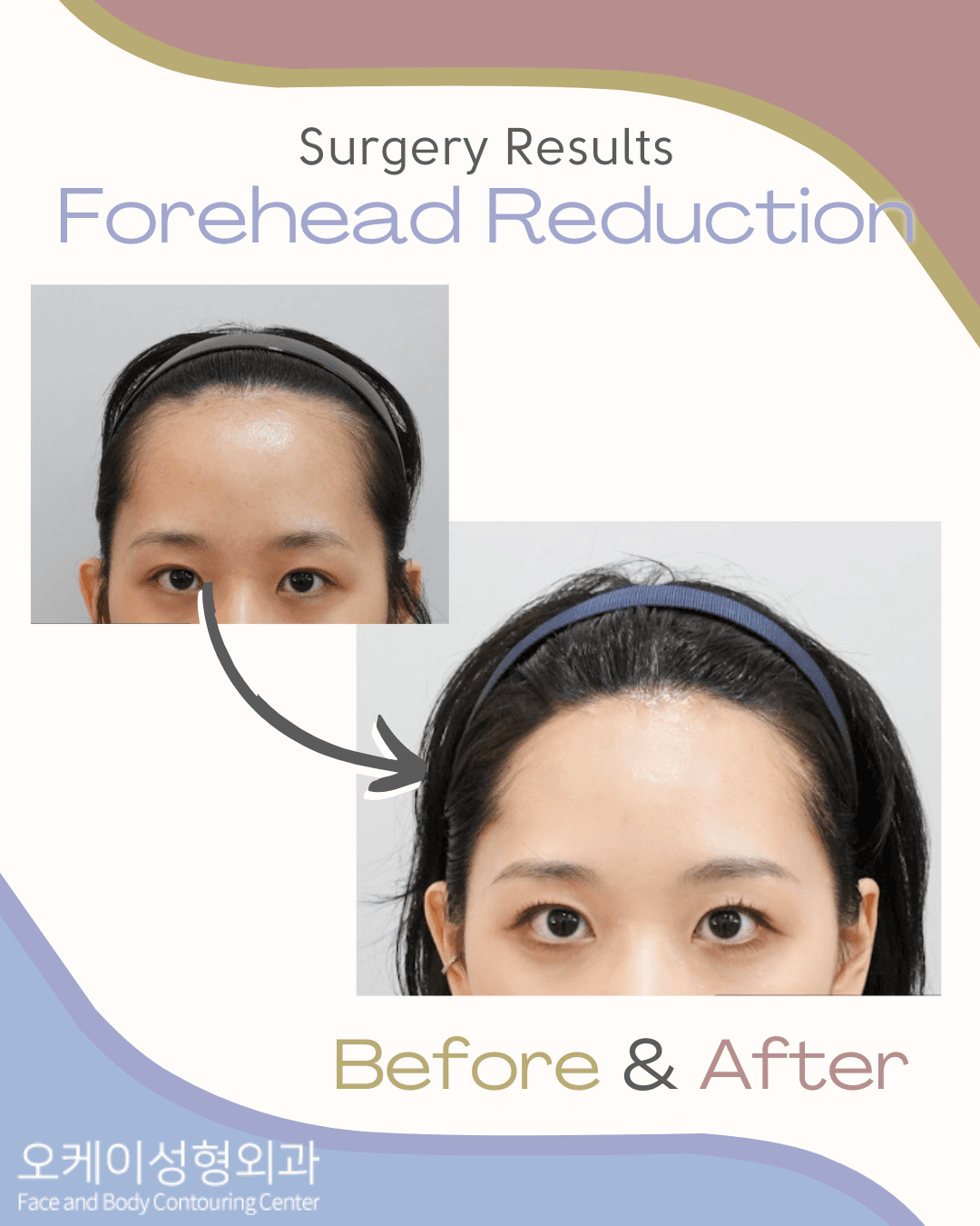 Okay Plastic Surgery Clinic before and after image