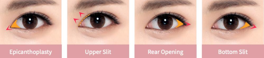 Canthoplasty, Laser Canthoplasty