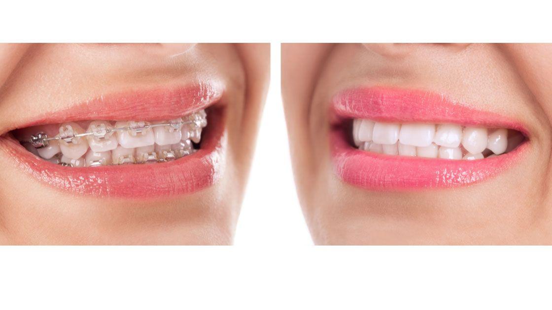 Braces