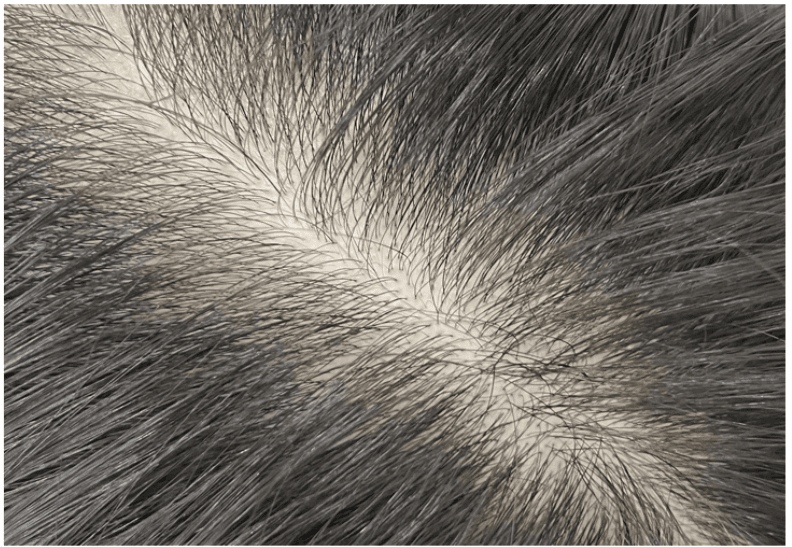 Scalp Micropigmentation