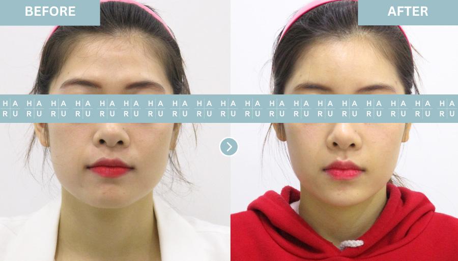 Thread Lift & Full Face Filler