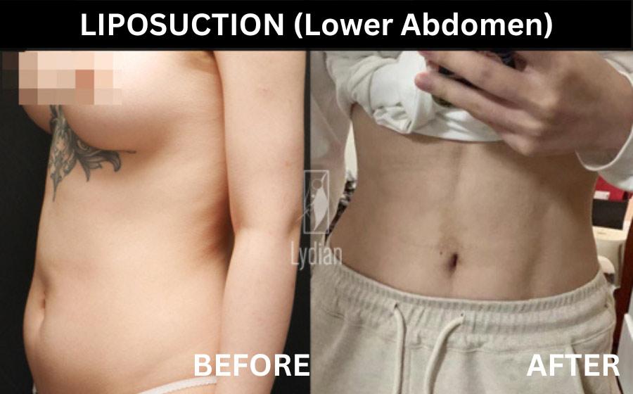 Lydian Plastic Surgery Clinic before and after image