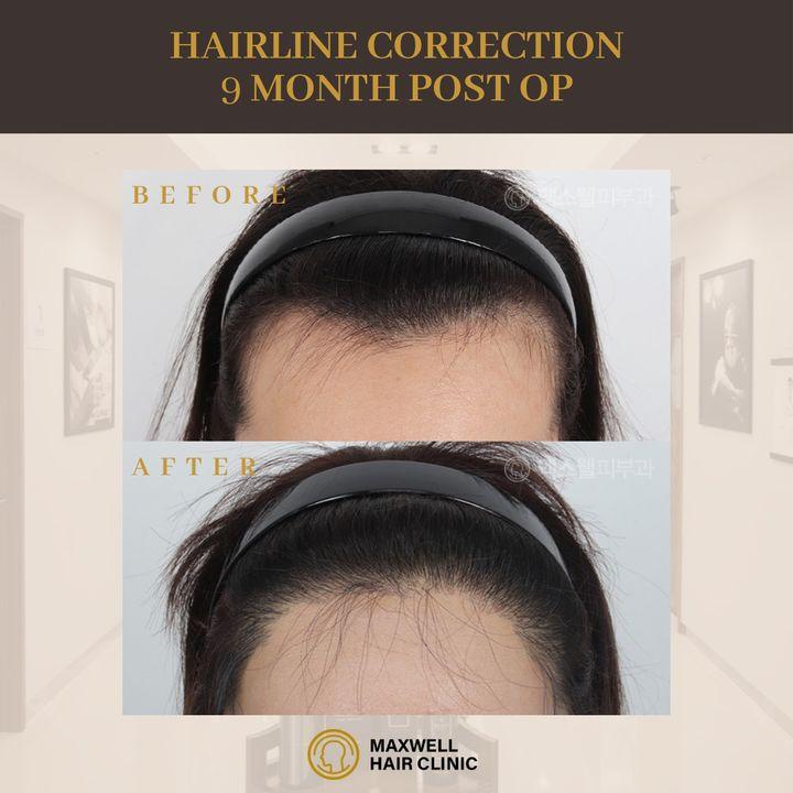 Nine months to a renewed confidence. Our hairline correction shows what Maxwell can achieve, one hair at a time.