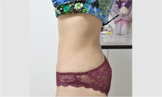 Before Tummy Tuck