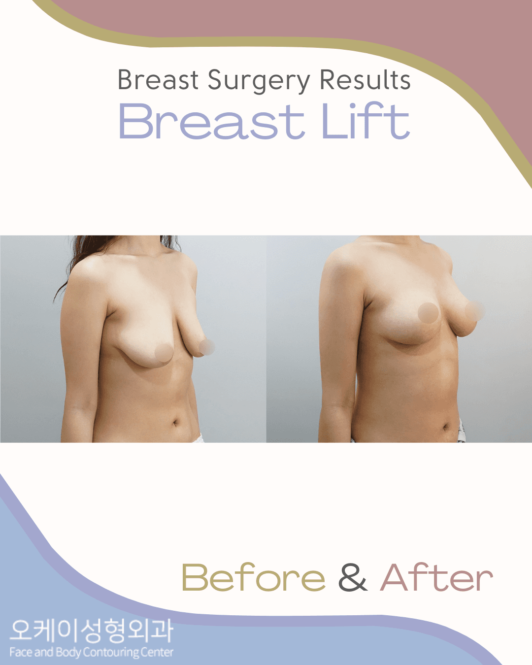 Okay Plastic Surgery Clinic before and after image