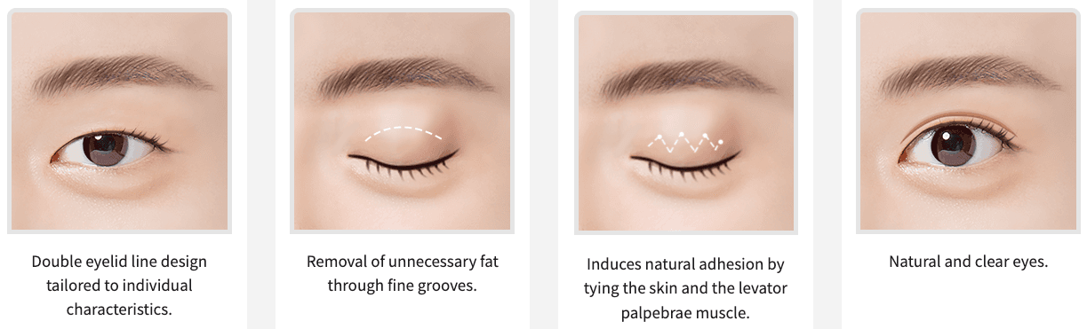Double Eyelid Surgery