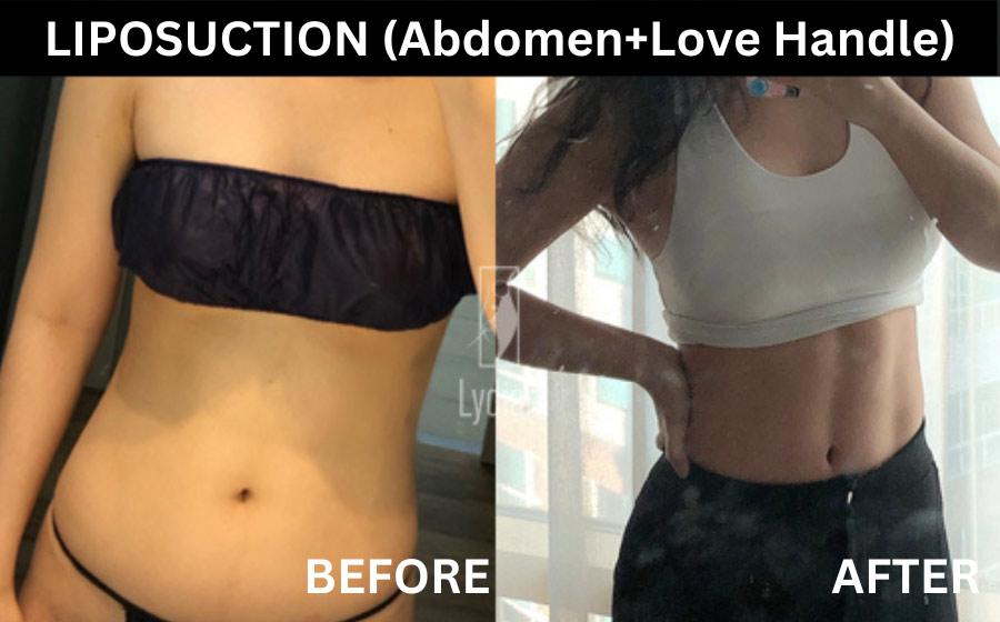 Lydian Plastic Surgery Clinic before and after image
