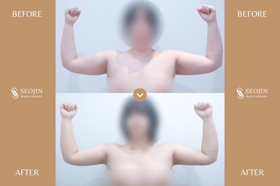 Vorher-Nachher-Bild der Seojin Plastic Surgery Clinic